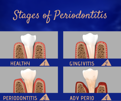 stages of perio